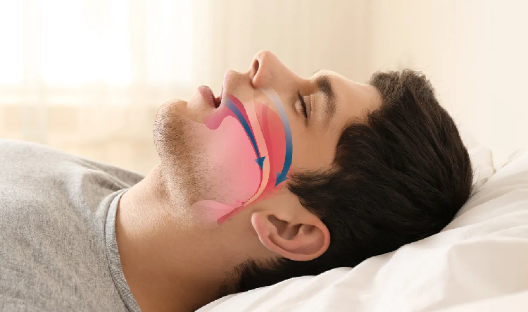 UYKU APNESİNİN 9 ÖNEMLİ BELİRTİSİ! UYKU APNESİNİN 9 ÖNEMLİ BELİRTİSİ!